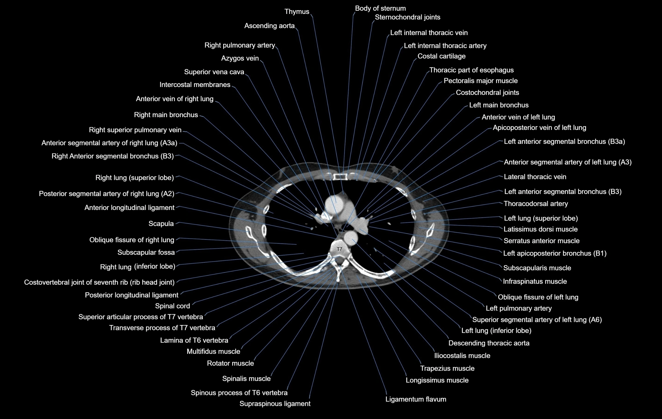 CT chest (thorax) soft tissue window labelled axial cross sectional anatomy radiology image-00052.webp